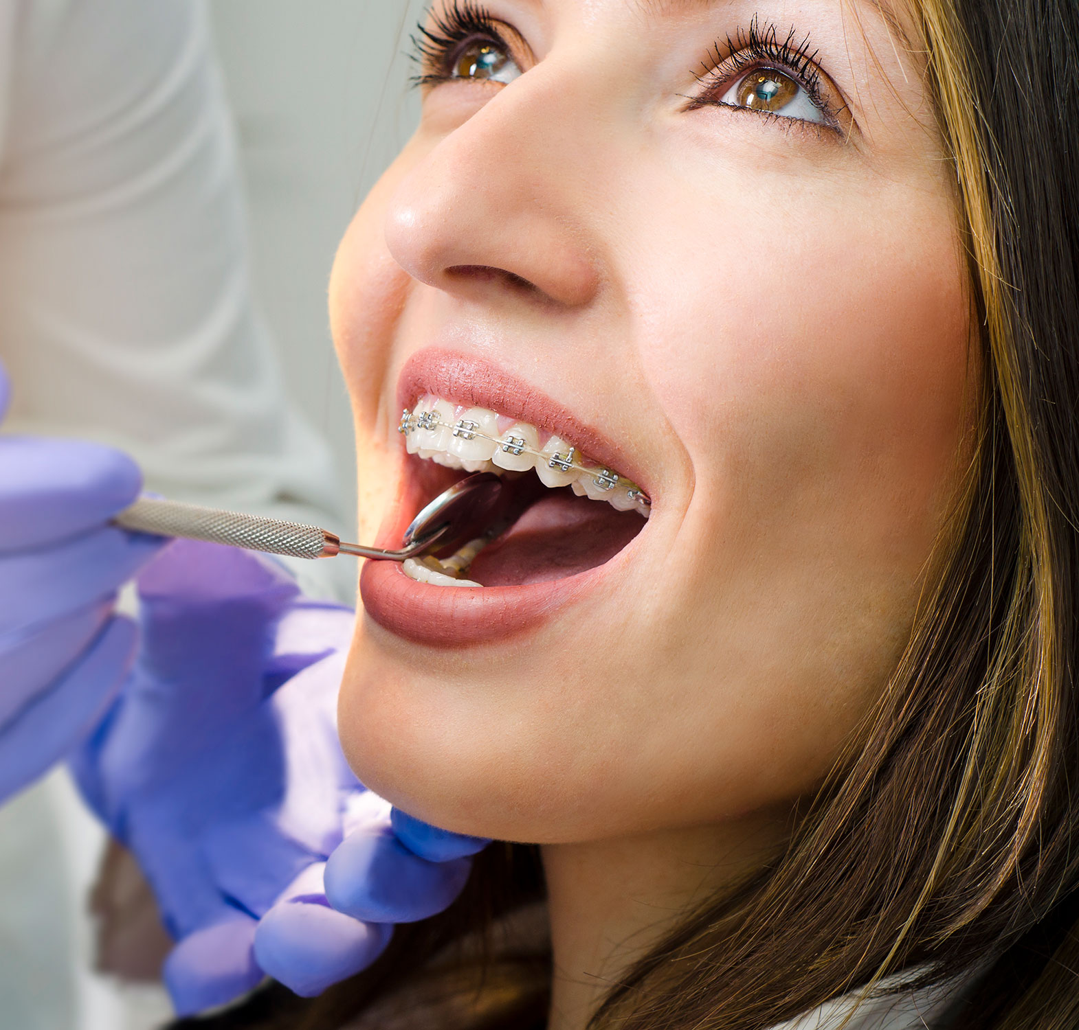 Metal Braces West Covina CA